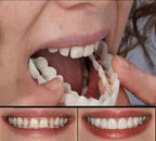 FitFlex Opzetgebit Met Natuurlijke Glimlach