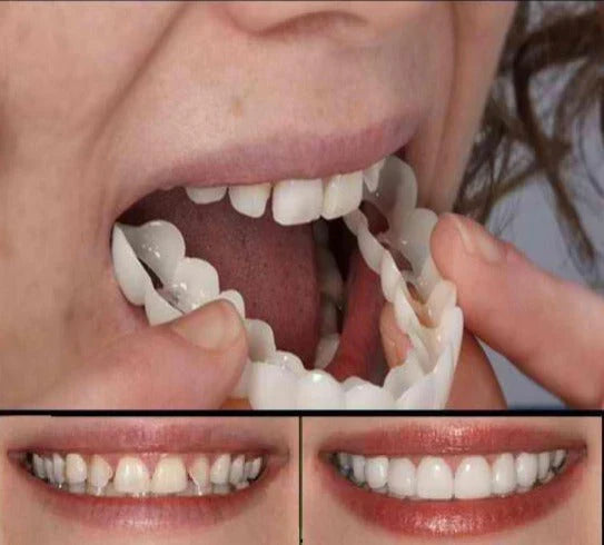FitFlex Opzetgebit Met Natuurlijke Glimlach