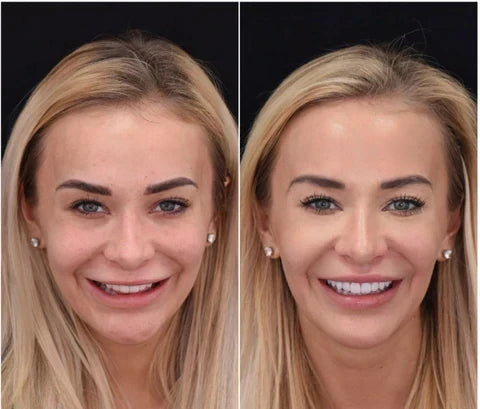 Cosmetische Boven‑ en Onderbitjes met Directe Natuurlijke Look