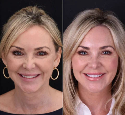 Cosmetische Boven‑ en Onderbitjes met Directe Natuurlijke Look