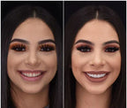 Cosmetische Boven‑ en Onderbitjes met Directe Natuurlijke Look