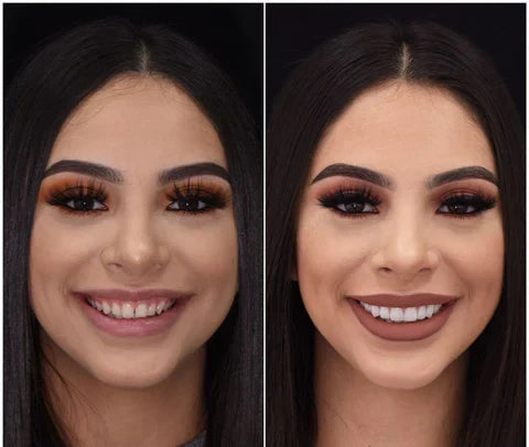 Cosmetische Boven‑ en Onderbitjes met Directe Natuurlijke Look